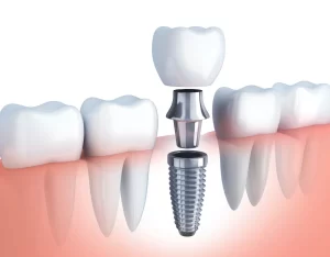 implante-dental