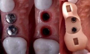 Caso realizado en esthetic dental center