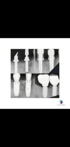 Caso realizado en esthetic dental center