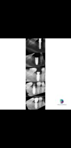 Caso realizado en esthetic dental center