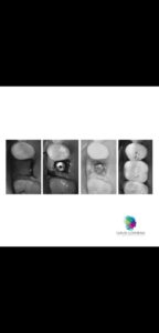 Caso realizado en esthetic dental center