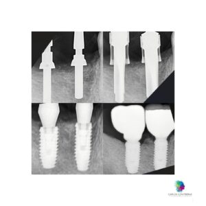 Caso realizado en esthetic dental center