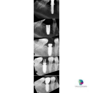 Caso realizado en esthetic dental center