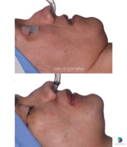 Paciente clase III más abordaje zona malar