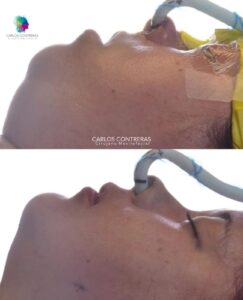 Paciente clase III más implante de silicona en zona malar