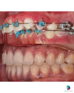 Distracción osteogenica seguimiento a 8 años