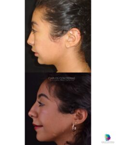 Distracción osteogenica seguimiento a 8 años