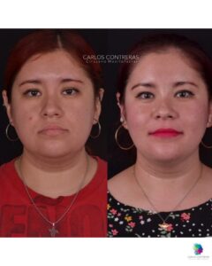 Corrección asimétria facial