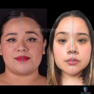 Corrección asimétria facial