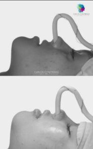 Avance maxilar más lipotransferencia en labios y zona malar