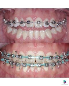 corrección mordída abierta anterior con cirugía ortognática