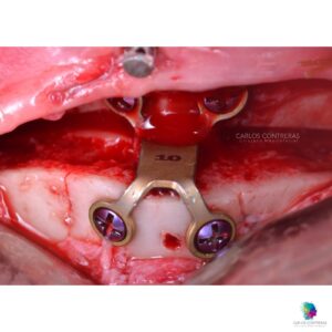 Mentonplastia de avance