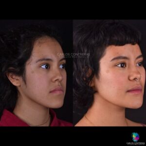 Avance maxilar y mentoplastia de reducción