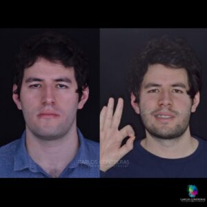 3 días postoperatorio de cirugía de avance maxilar