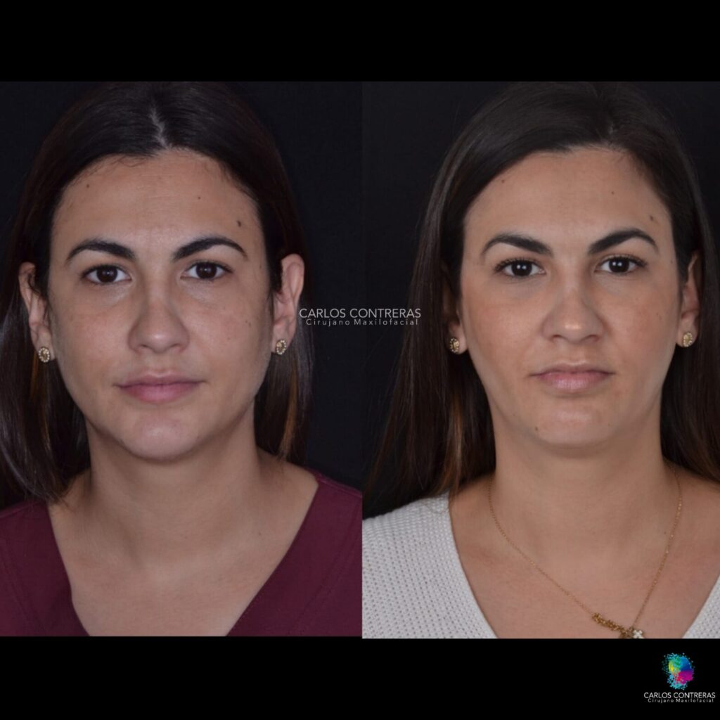 Botox maseterino para tratamiento de disfuncion de ATM