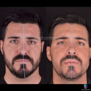 6 semanas postoperatorio de cirugía Ortognatica