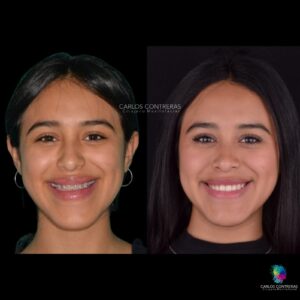 Seguimiento a 5 Años de Cirugía Ortognática