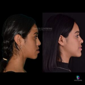 Seguimiento a 5 Años de Cirugía Ortognática